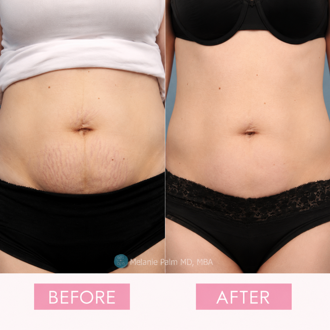Bio-Oil Skincare Oil – Smooth Scars, Erase Stretch Marks & Lock in Radiant Hydration – Multi-Purpose Oil for Scars, Stretch Marks, Uneven Skin Tone & Dry Skin – With PurCellin Oil™, Vitamin A, Vitamin E & Botanical Oils