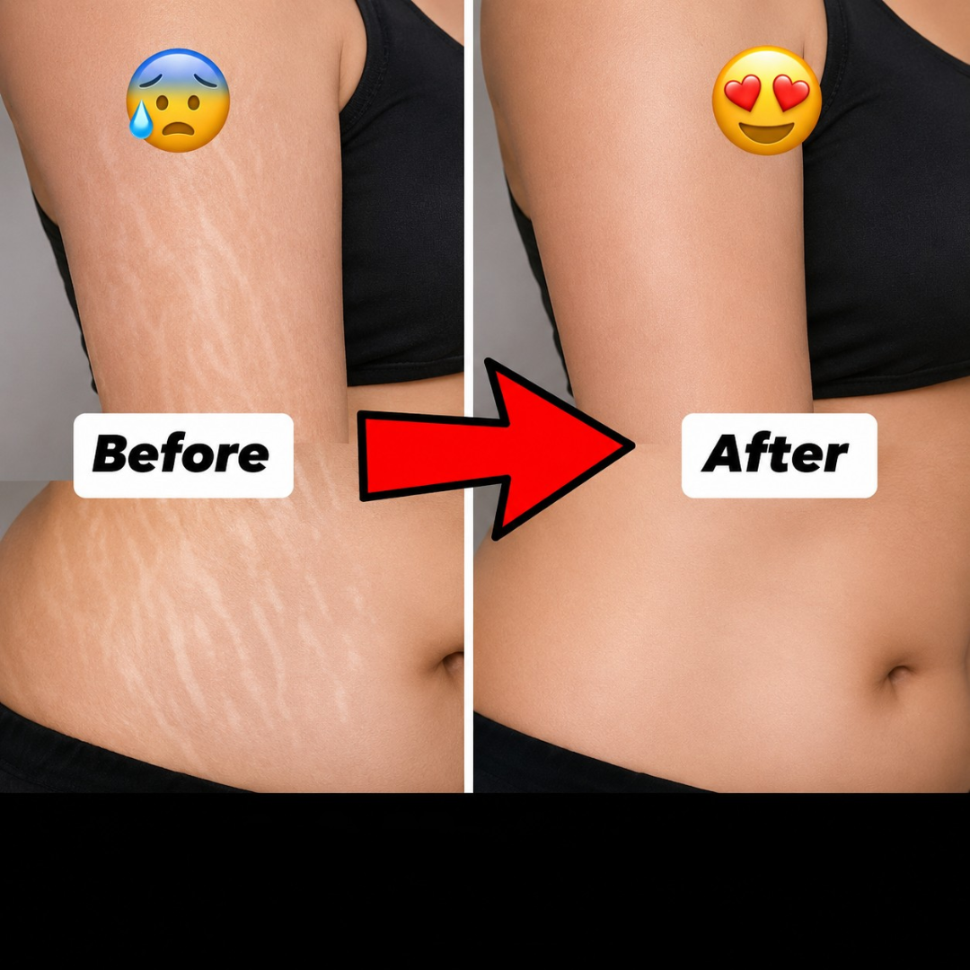 Bio-Oil Skincare Oil – Smooth Scars, Erase Stretch Marks & Lock in Radiant Hydration – Multi-Purpose Oil for Scars, Stretch Marks, Uneven Skin Tone & Dry Skin – With PurCellin Oil™, Vitamin A, Vitamin E & Botanical Oils