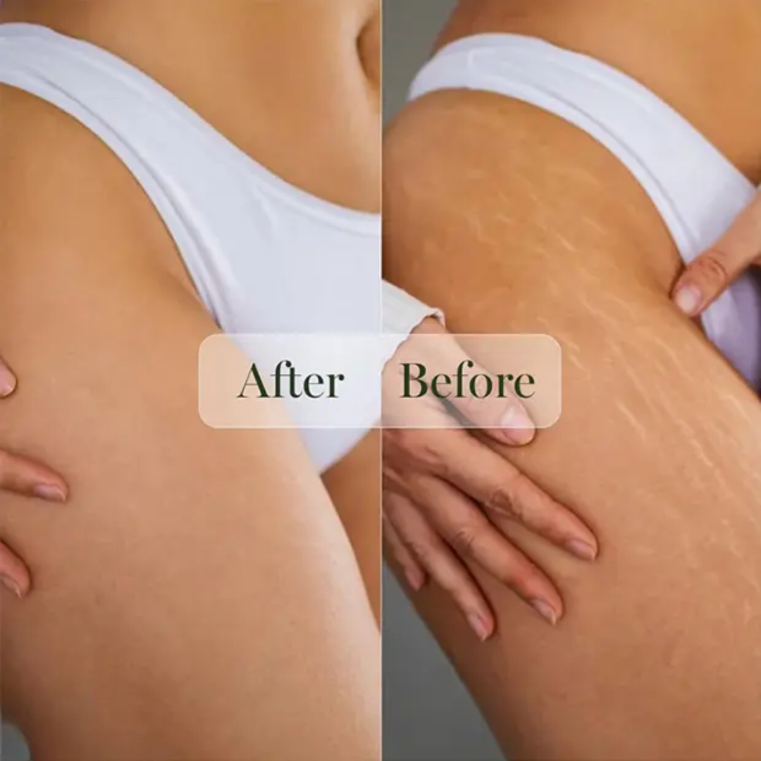 Bio-Oil Skincare Oil – Smooth Scars, Erase Stretch Marks & Lock in Radiant Hydration – Multi-Purpose Oil for Scars, Stretch Marks, Uneven Skin Tone & Dry Skin – With PurCellin Oil™, Vitamin A, Vitamin E & Botanical Oils